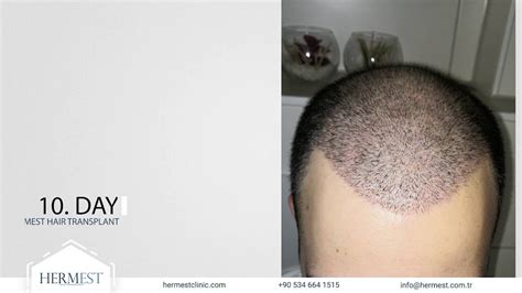 hermes haartransplantation|hermest hair transplant turkey.